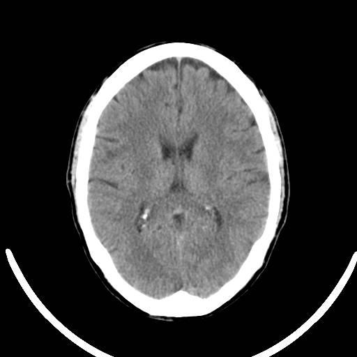 Diagnóstico de cefaleia - Tomografia