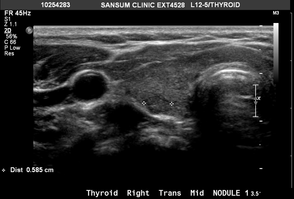 overdiagnosis - ultrassom de tireoide - nodulo de tireoide - raciocínio clínico