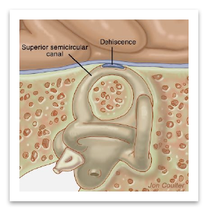 os-tres-pilares-do-diagnostico-correto-deiscencia-do-canal-semicircular-superior