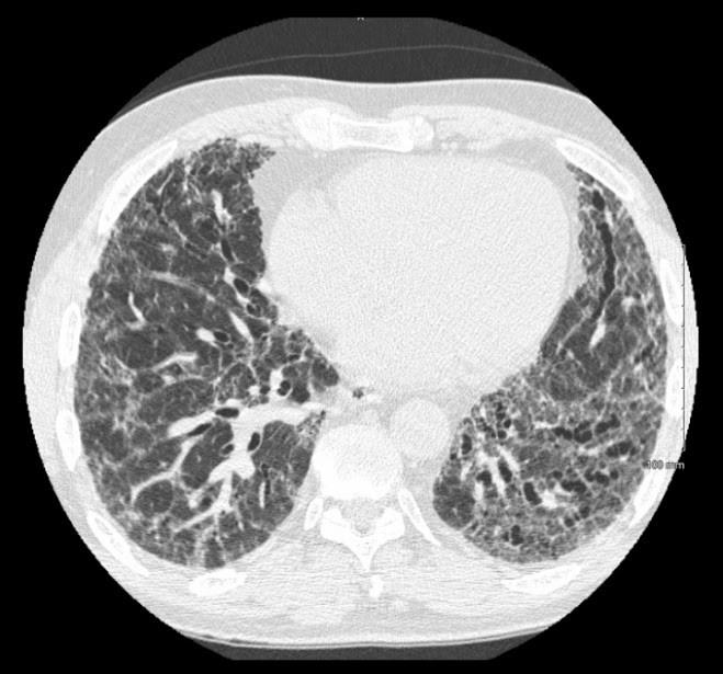 tomografia-torax-webcaso-12-raciocinio-clinico